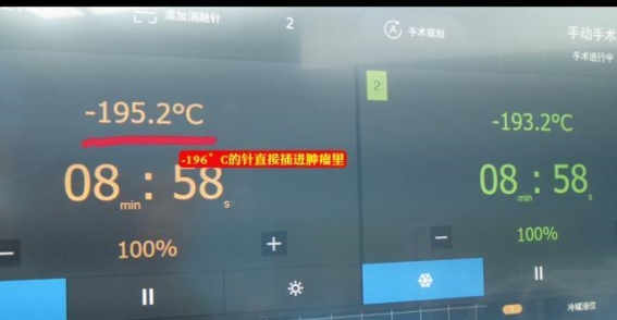 氩氦刀冷冻消融术：微创抗癌的未来希望