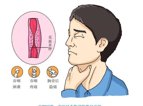 夫妻双双患食管癌，警惕这些饮食习惯的隐患
