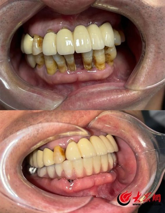 东营市第五人民医院口腔科创新突破：半口牙齿即拔即种即修复技术