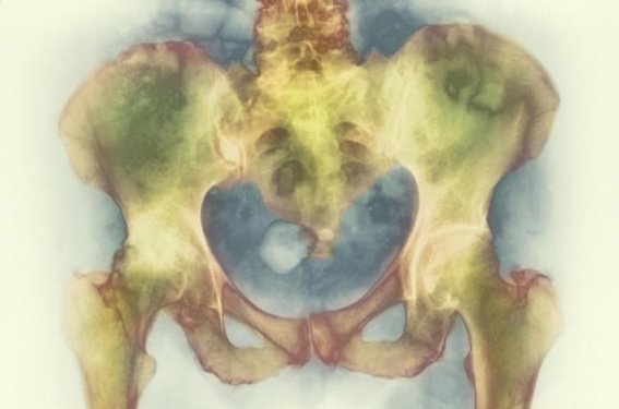常被忽视的补骨药，助力股骨头坏死的康复之路