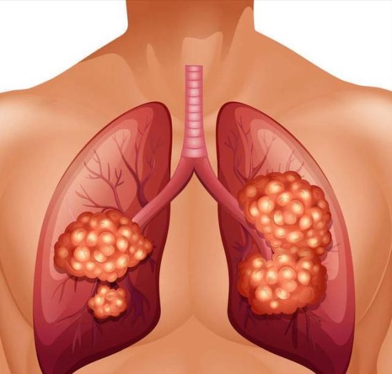 肺癌手术后，别忘了这3件事，决定你的生死存亡