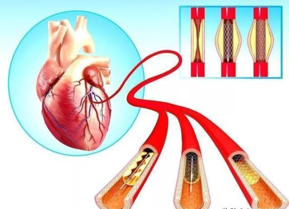 心脏支架手术的真相：一场误解与事实的较量