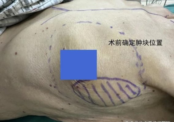 多学科协作助力高龄乳腺癌患者成功手术