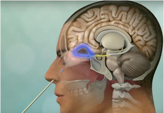 微创技术赋能脑膜瘤治疗：经鼻内镜切除术的新选择