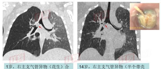 误吞异物如何应对？影像检查为生命护航