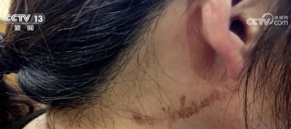 警惕毒隐翅虫：识别与正确应对指南