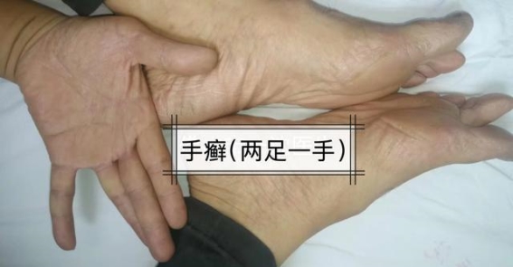 手指反复冒小水泡？皮肤科专家教你如何科学应对