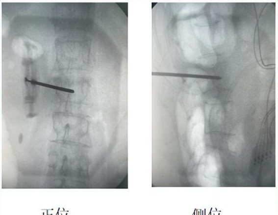 椎体成形术联合脊神经射频调控术显著缓解腰椎压缩骨折患者疼痛
