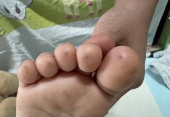 儿童健康警钟：当心“土方法”可能引发的危险