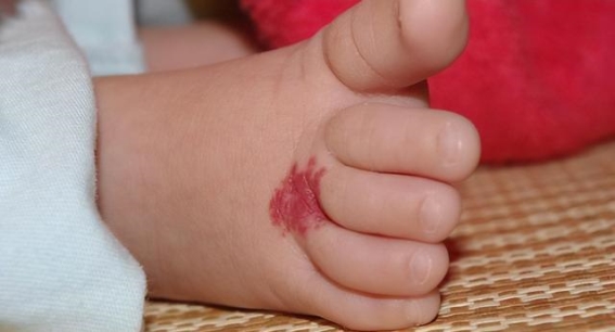 痣的象征与健康：认识痣的多重含义与注意事项