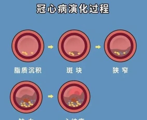 懒惰生活的隐患：冠心病、糖尿病与抑郁症的警钟