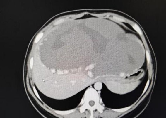 巨型肝血管瘤的成功剥离与微创手术