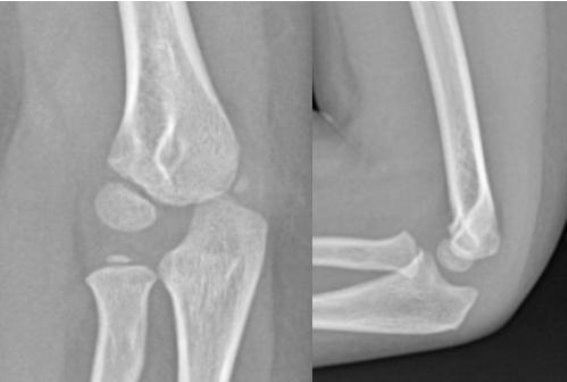 儿童骨折后恢复并非万事大吉，专家提醒家长关注这种移位的风险