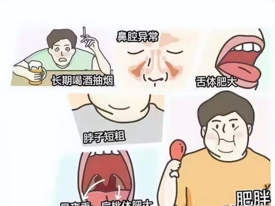 打呼噜背后的隐患：睡眠呼吸暂停综合征警示