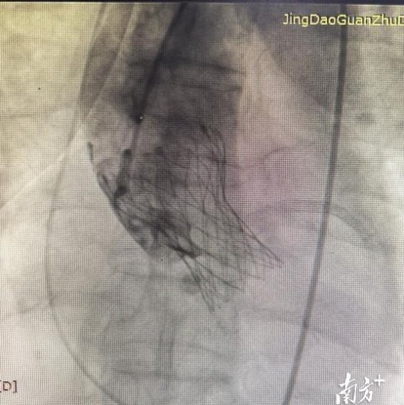 心脏的希望：68岁患者通过TAVR手术重获健康