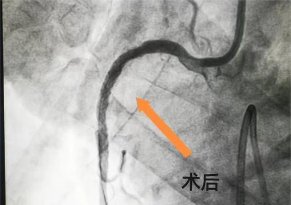 90岁急性心梗患者成功救治，莱芜人民医院上演生死时速