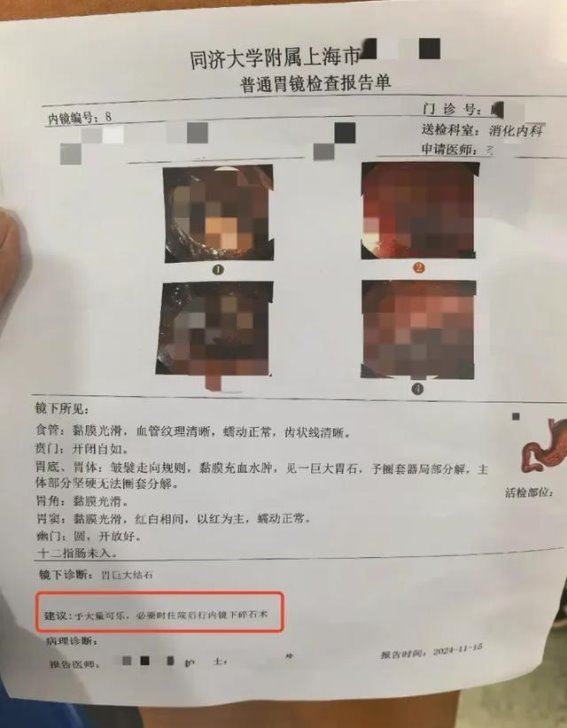 山楂的甜蜜陷阱：过量食用可能引发胃结石