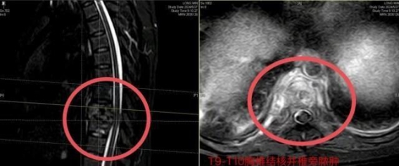 突如其来的疼痛背后：胸椎结核的隐秘威胁