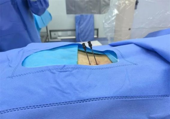 济南市莱芜人民医院微创技术助力缓解腰痛腿麻，康复疼痛科再创新突破