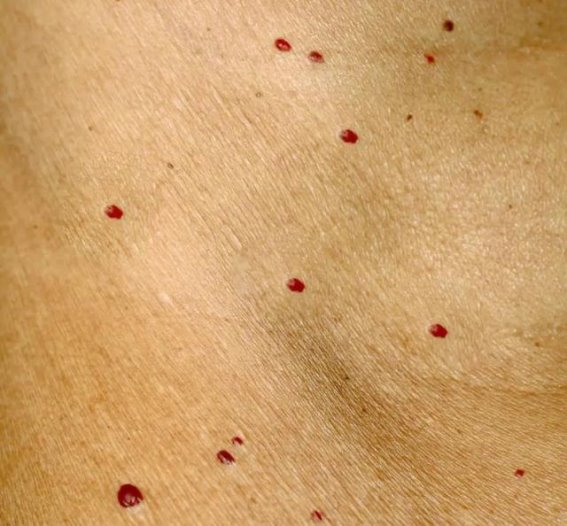 身上突然长的小红点，到底是什么？会癌变吗？