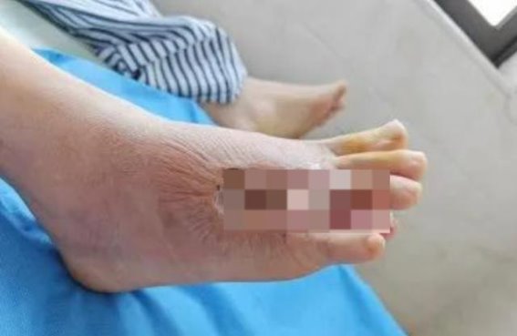 夏季蚊虫叮咬引发蜂窝织炎，东莞男子险失脚趾——健康防护要警惕
