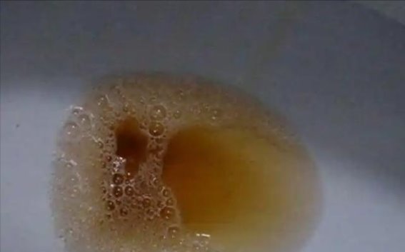 肾病引发的排尿异常信号，你注意到了吗？