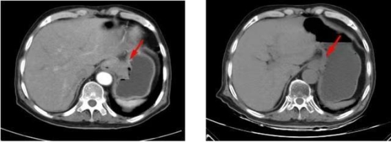 精准放疗助力高龄贲门癌患者临床完全缓解