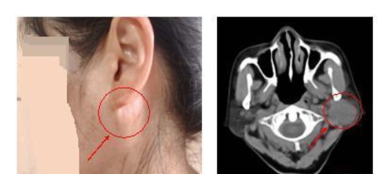 攻克高危禁区，武汉大学中南医院成功为带支架患者切除腮腺肿瘤