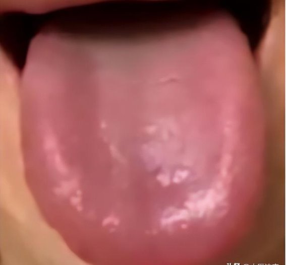 大腿根湿热的潜在危机，如何避免性功能问题的恶化