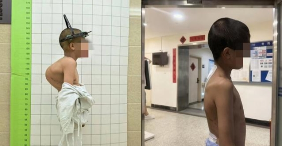 警惕遗传病“龙虾人”症状：脊柱侧弯早期干预至关重要