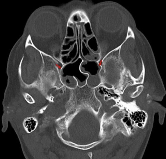 流感后细菌感染警惕——肺炎球菌性脑膜炎的临床表现与诊疗