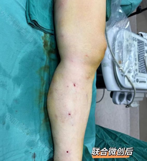 60岁阿姨微创治疗静脉曲张，轻松恢复，旅游计划不再受限