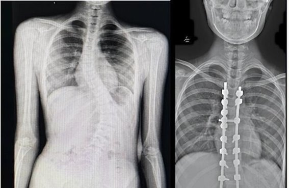 重拾自信的脊柱之旅——11岁女孩珍珍的故事