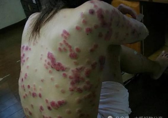 揭开“艾滋”谜团：从感染到生命尽头的三阶段艰辛旅程