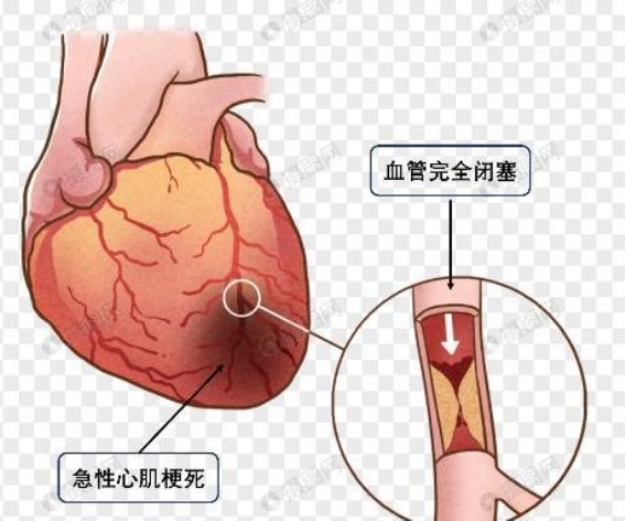心梗支架术后，如何科学合理地进行运动锻炼？