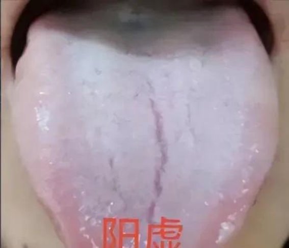 舌有裂纹寿难长！阳虚裂纹舌阴虚裂纹舌精虚裂纹舌，1次教你分清
