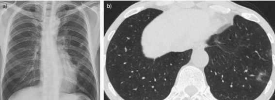 肺寄生虫病临床诊治必备指南